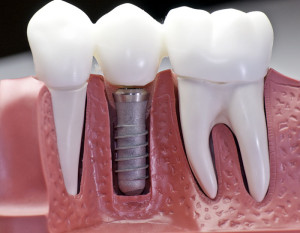 dantų implantacija Panevėžyje