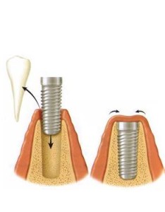 dantų implantacija penevėžyje implantai