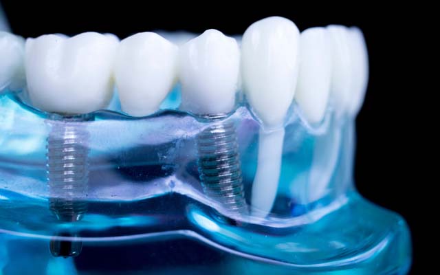 dantų implantacija implantai Panevėžyje